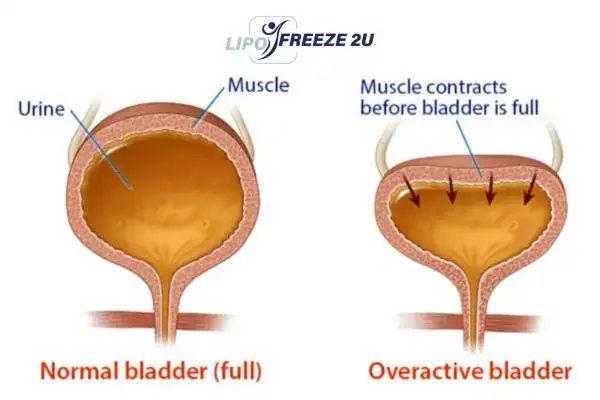 diagram of overactive bladder treatment Bedford