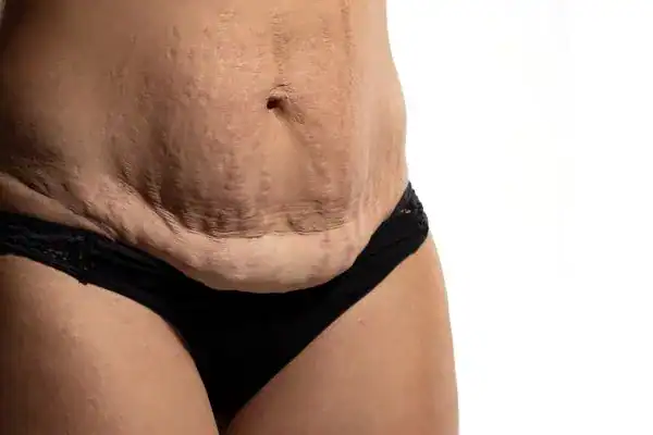 loose skin after weight loss injections Bedford