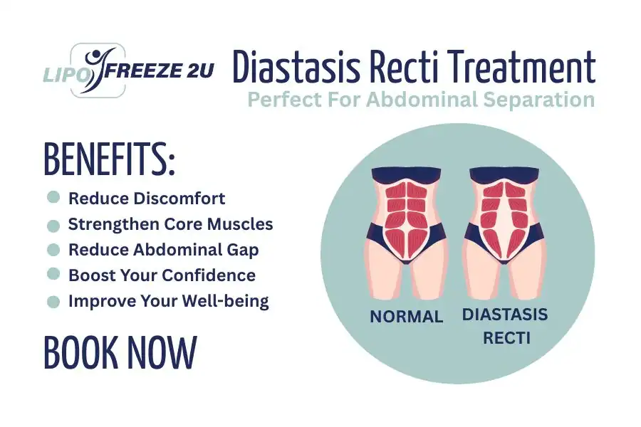 How Long Will It Take to See Improvements in Diastasis Recti Bedford