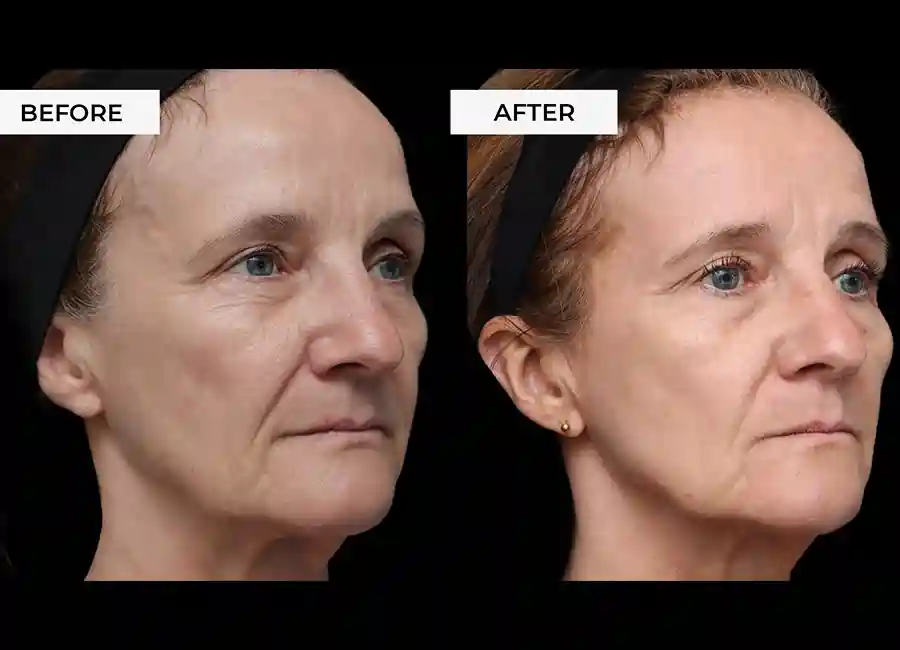 How Many RF Microneedling Sessions Will You Need to See a Difference Bedford?
