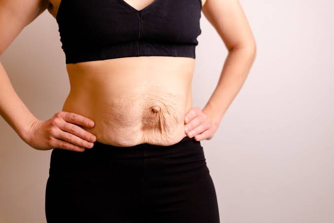 Is Surgery Really the Only Way to Repair Diastasis Recti Bedford?