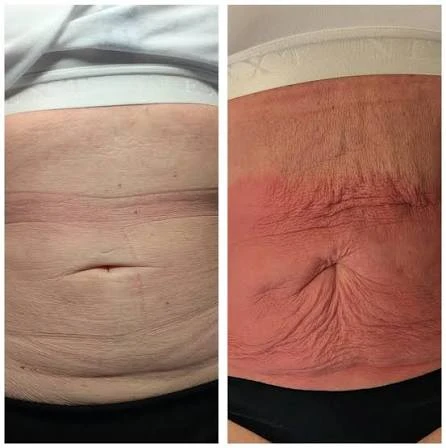 How Does RF Microneedling Improve Crepey, Thin and Uneven Skin Texture Bedford?