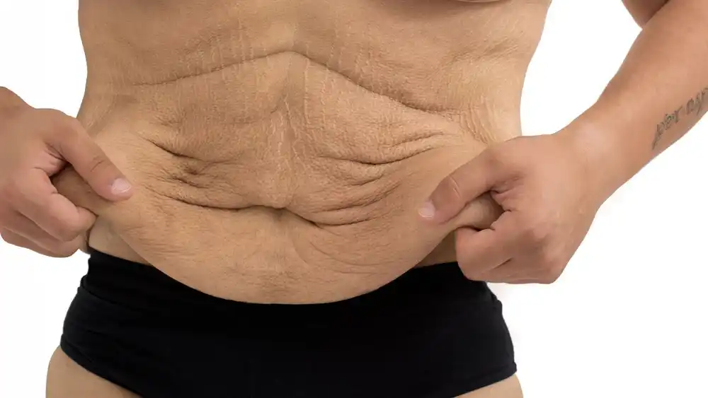 RF Microneedling for Loose Skin: How Can It Help Tighten and Reshape the Skin Bedford?